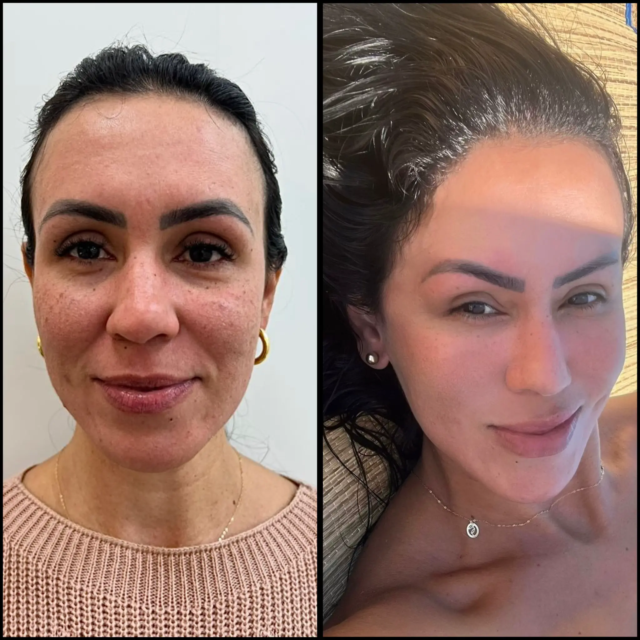 Brow lift before and after — natural, long-lasting result