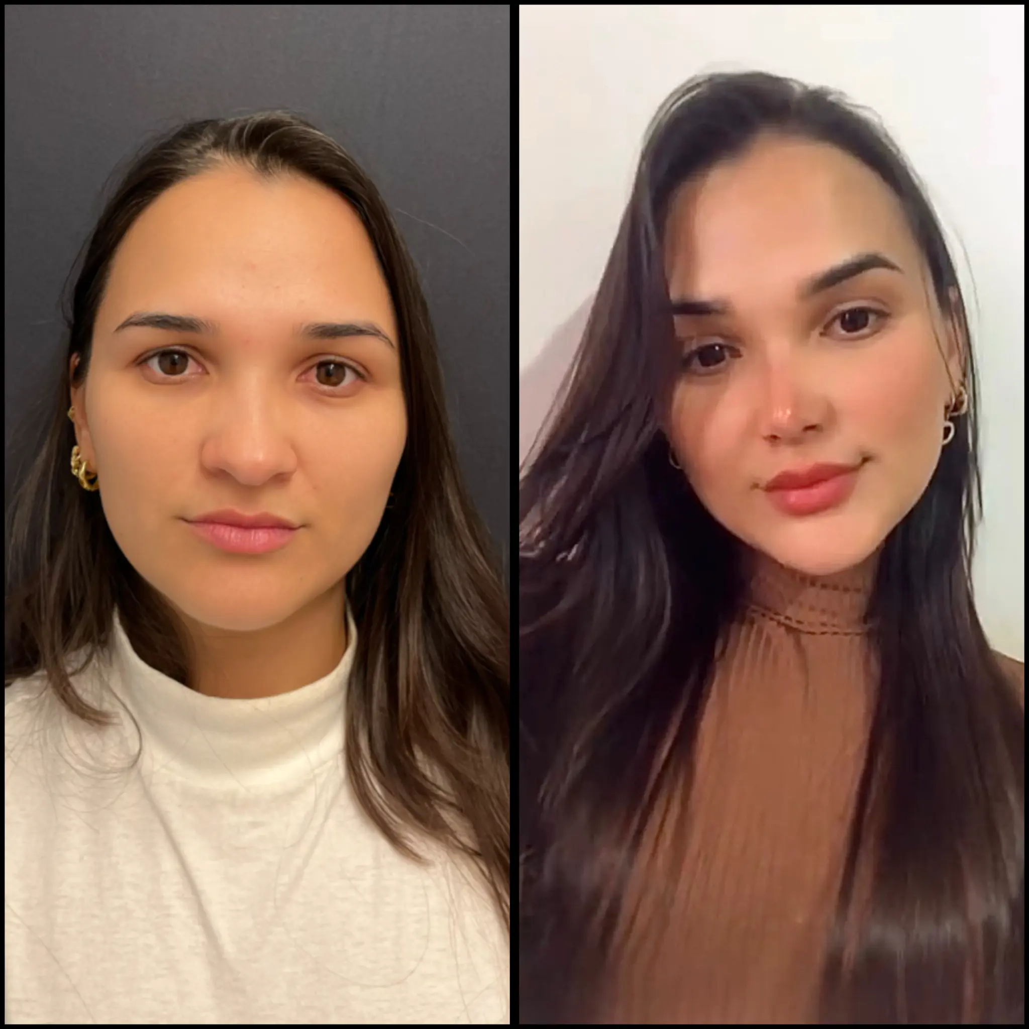 Facial lift result — angle three